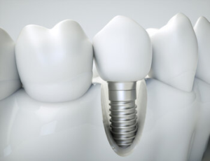 cover dental implants Sydney