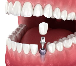 dental implant treatment gordon
