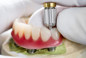 all 4 dental implants cost procedure killara