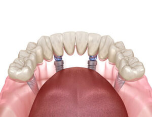 all 4 dental implants cost stability killara