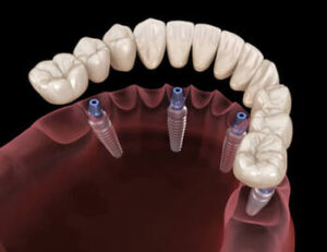 All On 4 Dental Implants placement killara