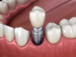 Dental Implants for Pensioners procedure killara